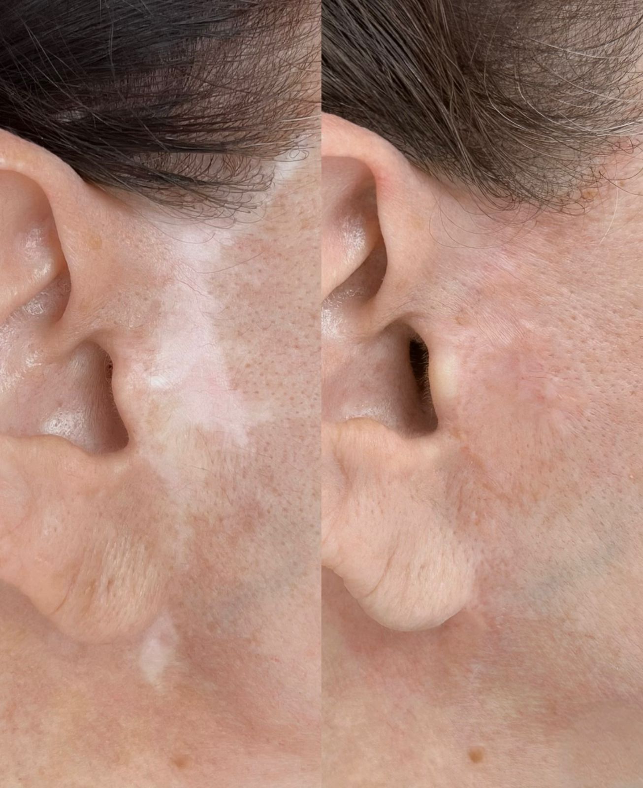 Antes e Depois Camuflagem 2