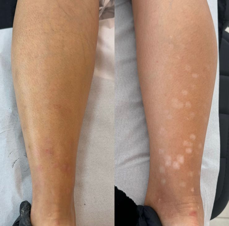 Antes e Depois Camuflagem 4