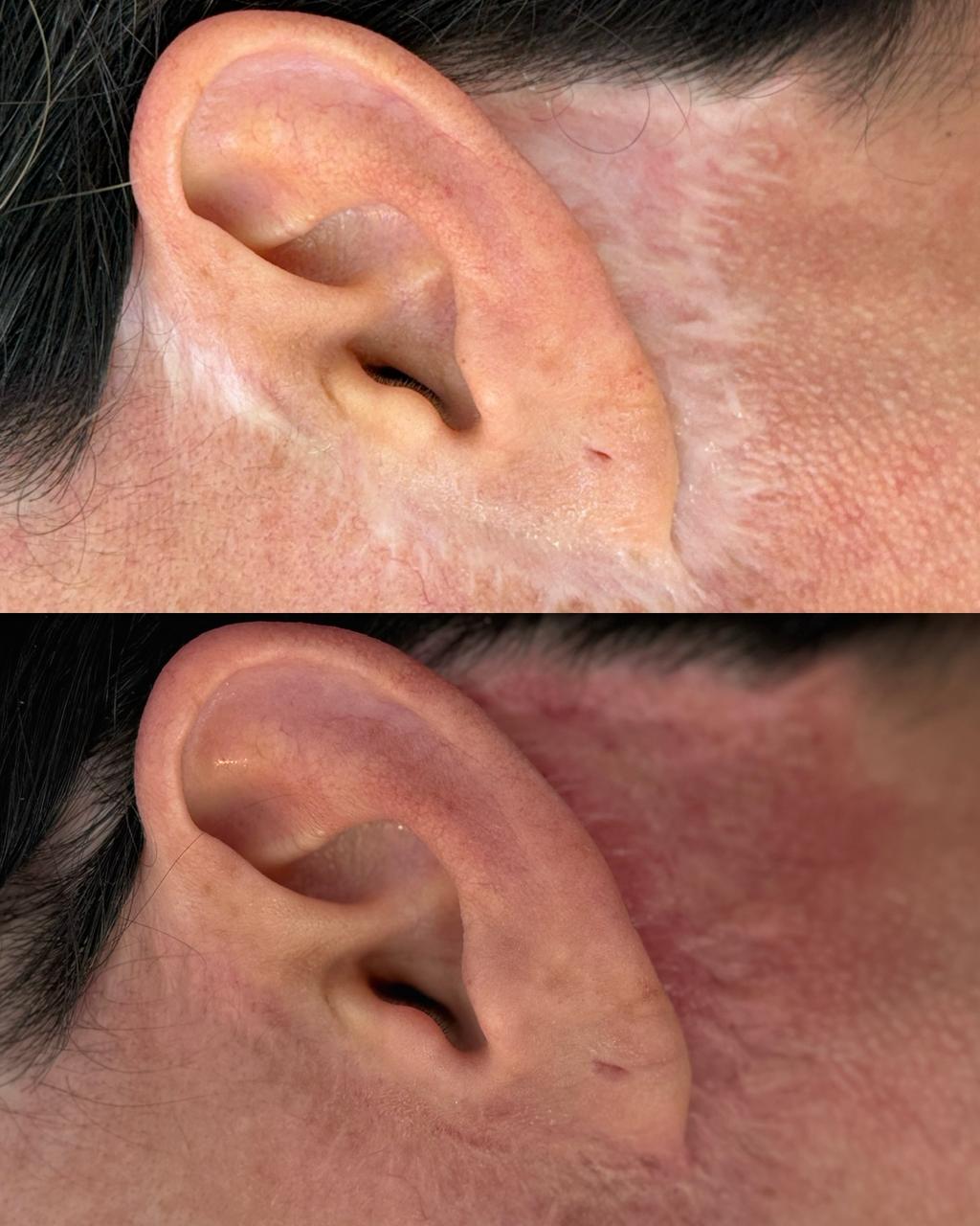 Antes e Depois Camuflagem 5