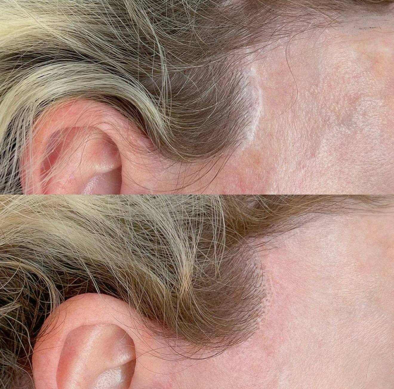 Camuflagem de Cicatrizes