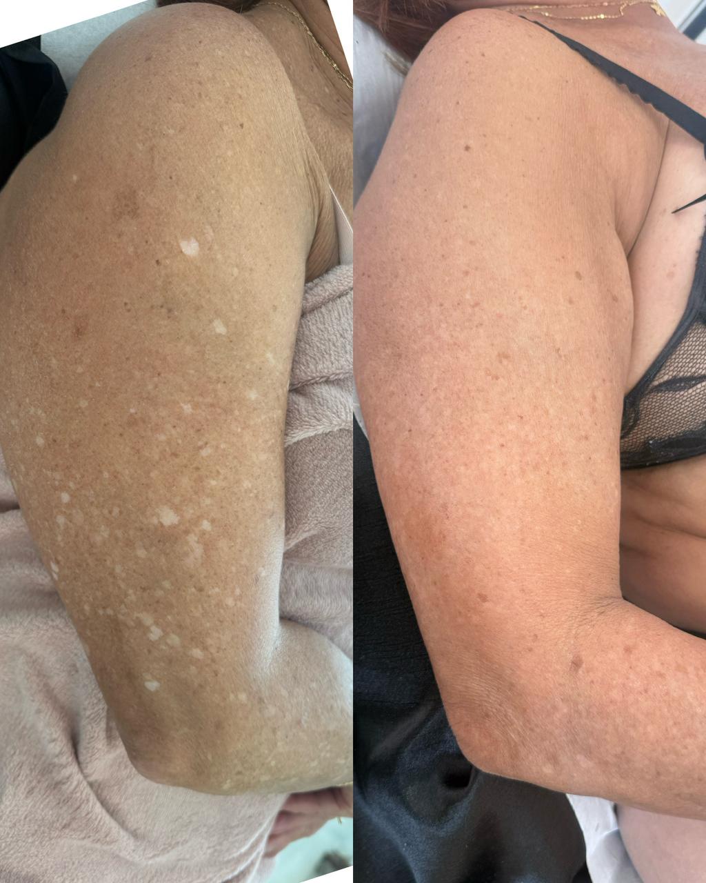 Antes e Depois Camuflagem 8