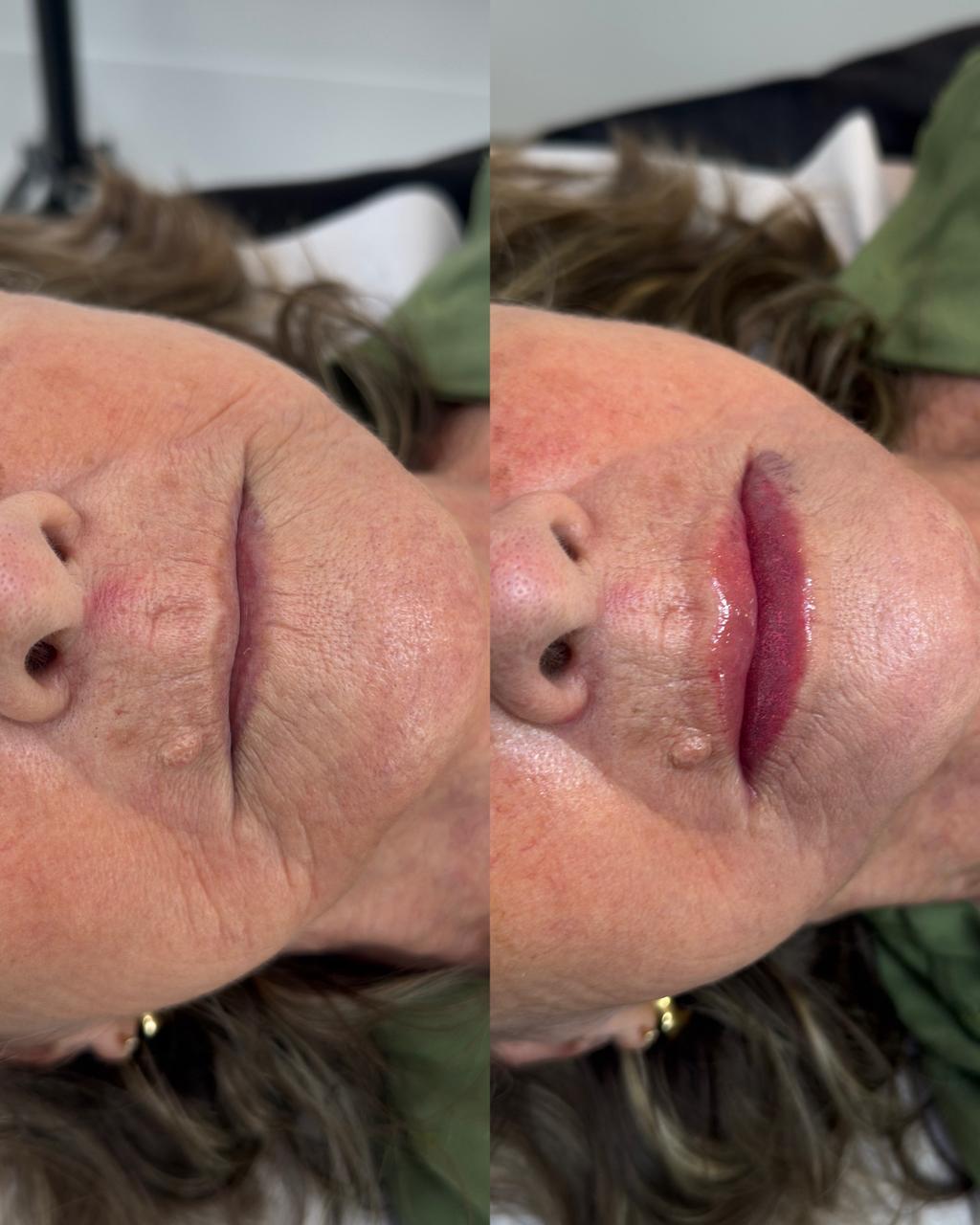 Resultado Labial 5