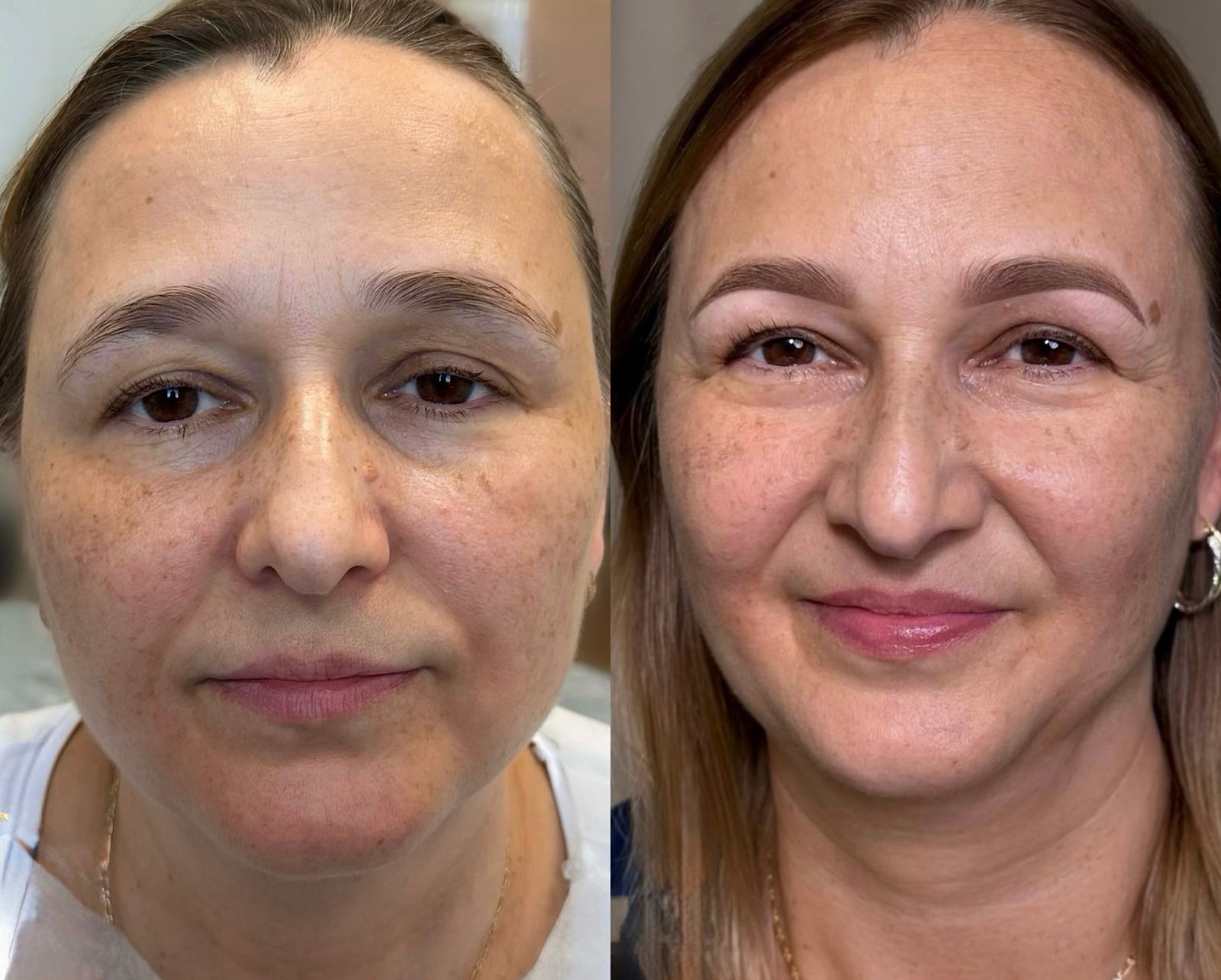 Antes e Depois Sobrancelha 4