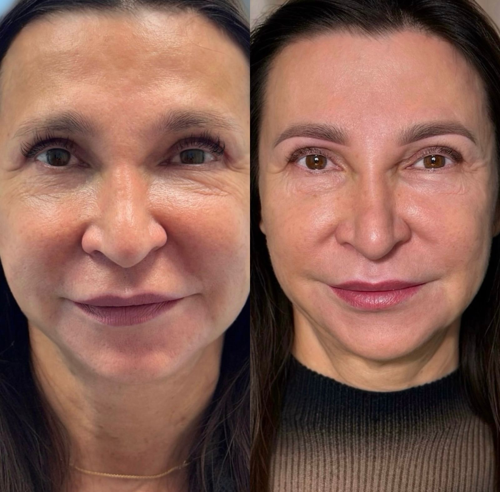 Antes e Depois Sobrancelha 6