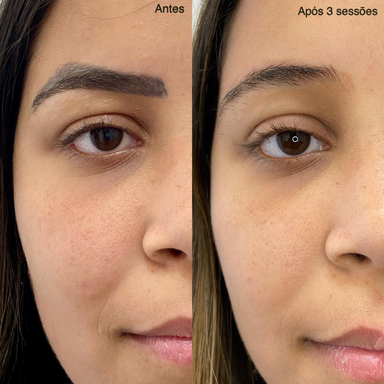 Antes e Depois Sobrancelha 9