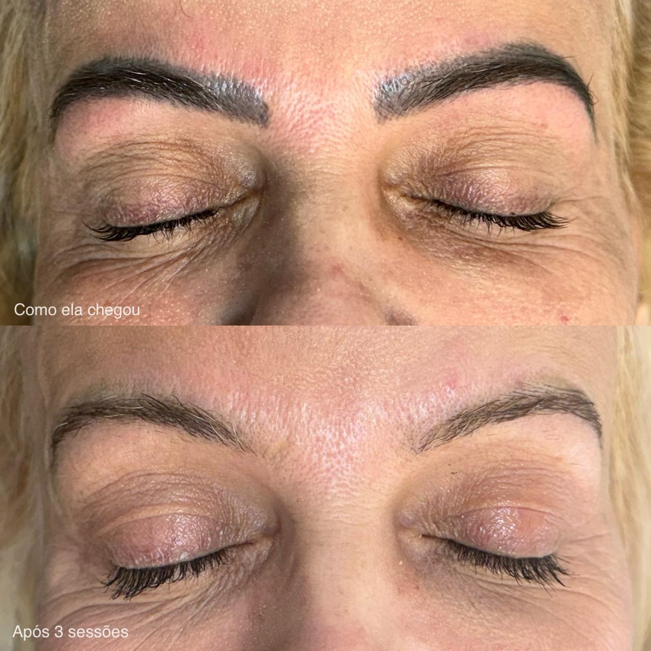 Antes e Depois Sobrancelha 13